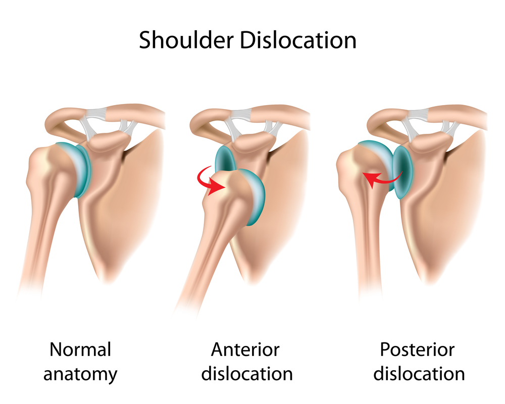 dislocated shoulder.jpg